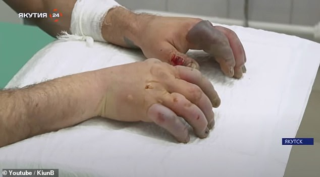 Показывая серию довольно жутких видеоклипов с местными жителями, получившими сильное обморожение пальцев, Киун объясняет: «Обморожение и переохлаждение почти так же распространены, как и простуда».